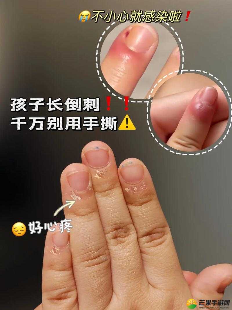 宝宝三根手指疼引关注